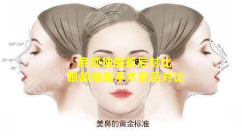 肩颈抽脂前后对比 眼部抽脂手术前后对比